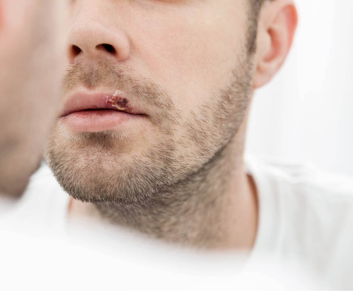 young man suffering from herpes on his mouth utc jpg
